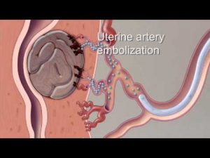 Fibroid Treatment Options – Mayo Clinic