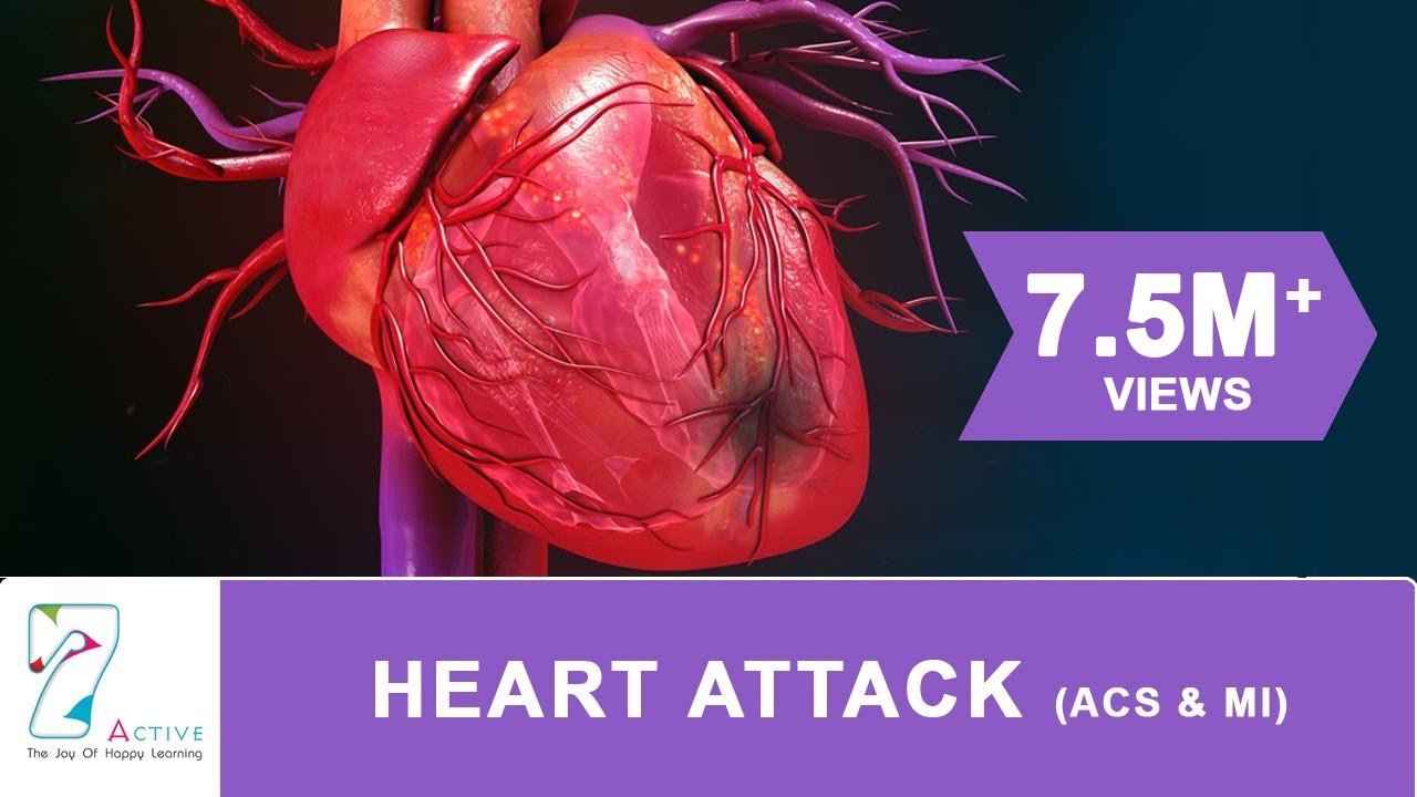 You are currently viewing HEART ATTACK (ACS & MI)