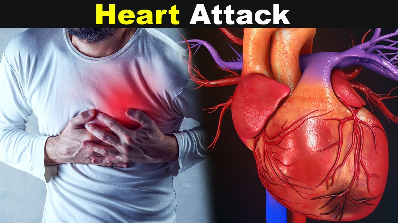 You are currently viewing Heart Attack (Mayocardial Infarction) | Symptoms,Causes And Treatments (Urdu/Hindi)