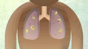How The Body Reacts To Tuberculosis