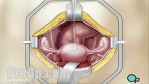 Hysterectomy Removal of Uterus, Ovaries and Fallopian Tubes Surgery PreOp® Patien Education