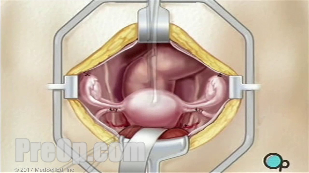 You are currently viewing Hysterectomy Removal of Uterus, Ovaries and Fallopian Tubes Surgery PreOp® Patien Education