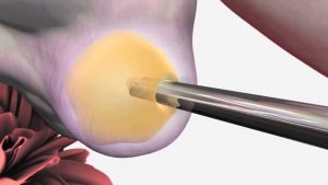In Vitro Fertilization | Santa Monica Fertility