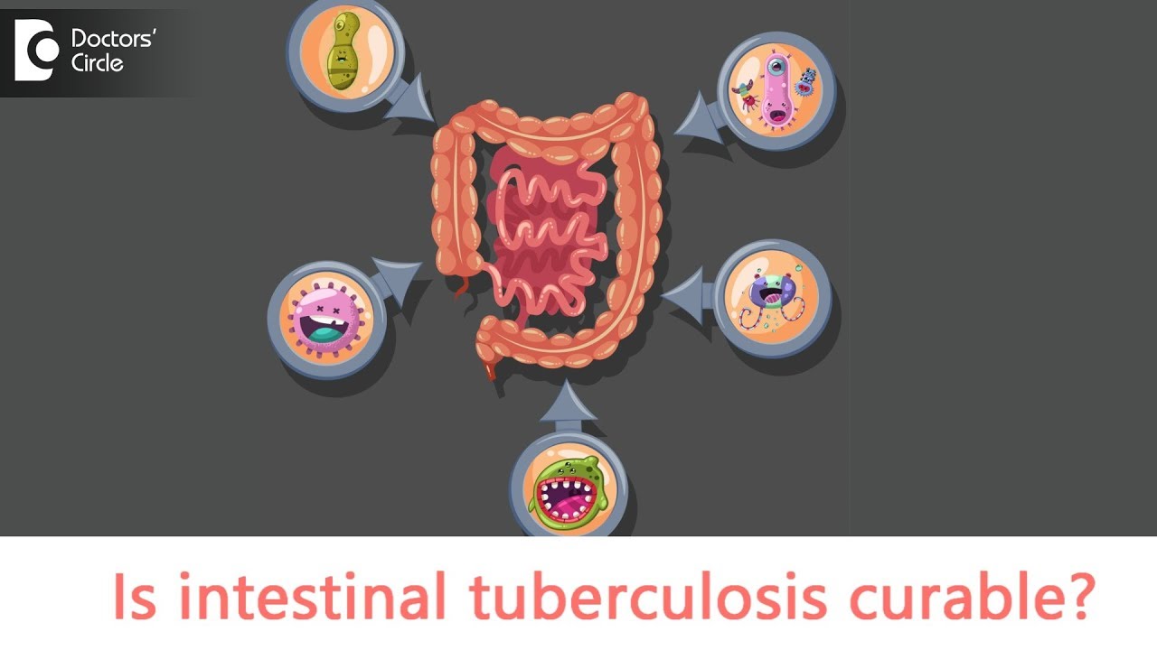 You are currently viewing Intestinal tuberculosis – Causes, Symptoms | Is intestinal TB contagious? – Dr. Rajasekhar M R