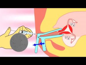 Read more about the article Intrauterine insemination (IUI) video.flv about infertility and ivf treatment