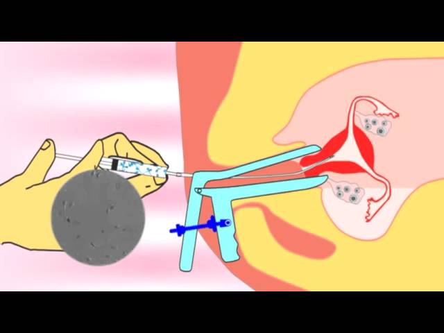 You are currently viewing Intrauterine insemination (IUI) video.flv about infertility and ivf treatment