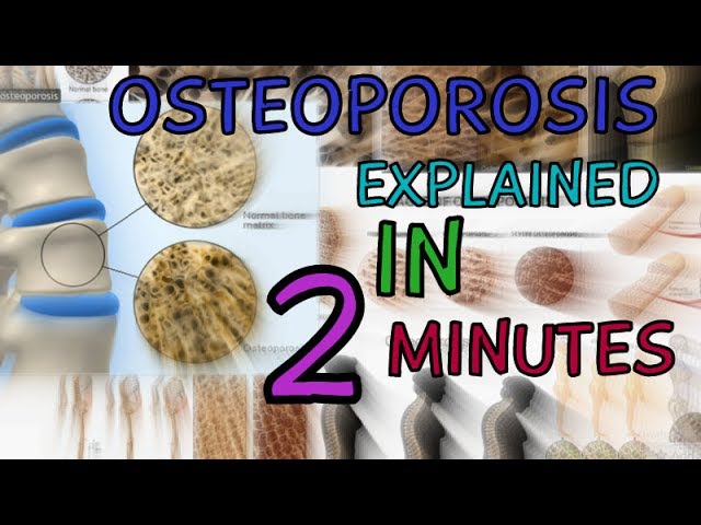 You are currently viewing OSTEOPOROSIS | EXPLAINED IN 2 MINUTES  | CAUSES | SYMPTOMS | TREATMENT – WHAT IS OSTEOPOROSIS?