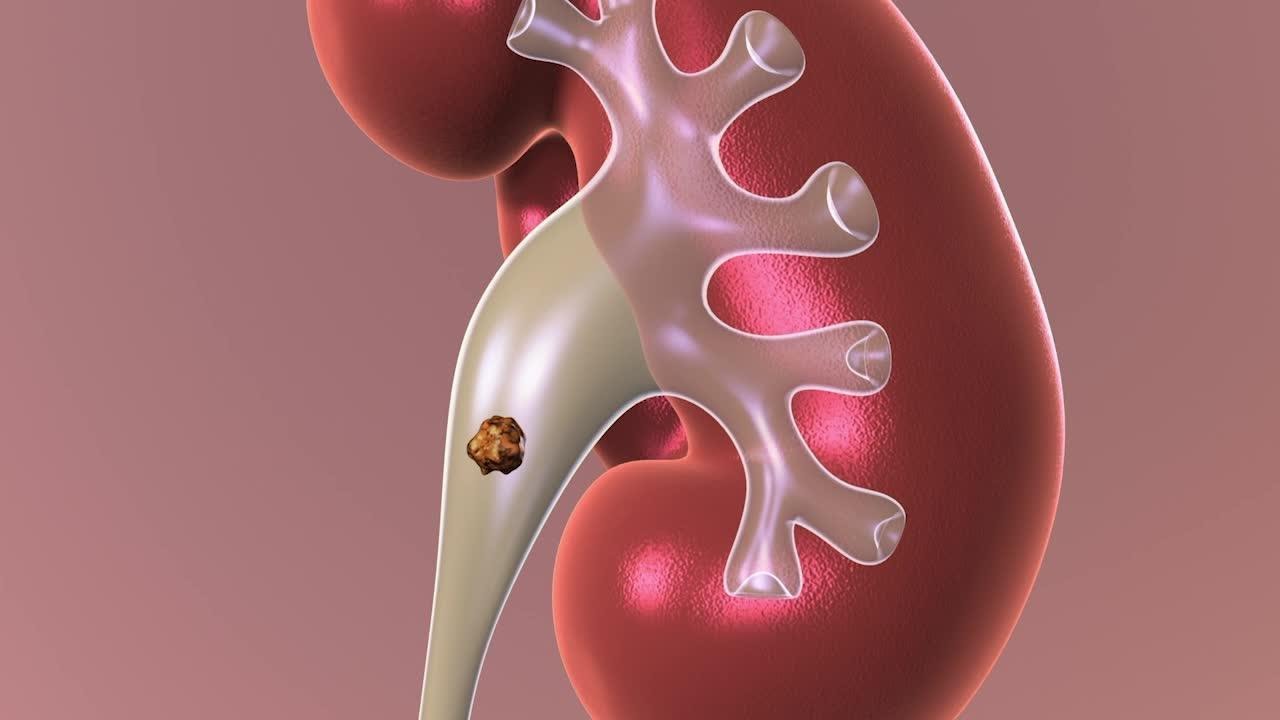 You are currently viewing Observation: Non-surgical Approach to Kidney Stones