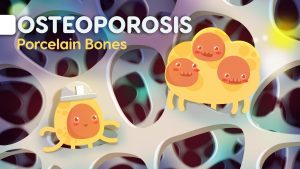 Read more about the article Osteoporosis symptoms and causes – Everything you need to know explained easily