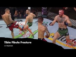 Sport Injury : Fracture of Tibia & Fibula (Conor McGregor) Shinbone broken