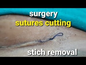 Stiches removal and dressing after cesarean section || घुलनशील टाँको को काटना || suture removal