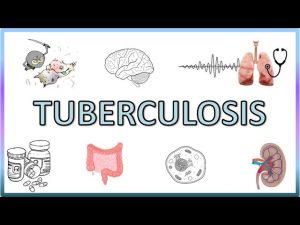 Tuberculosis – Types, Pathogenesis, Signs and Symptoms, Diagnosis, Treatment and Prevention