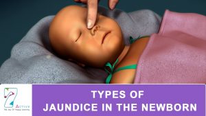 Read more about the article Types of Jaundice in Newborn
