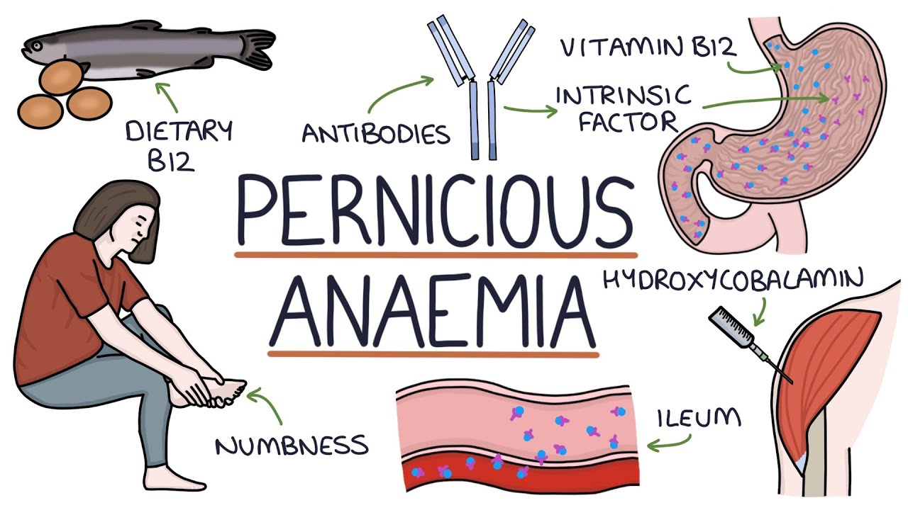 You are currently viewing Understanding Pernicious Anaemia: For Students