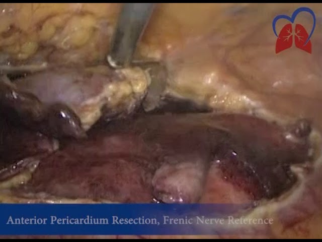 You are currently viewing VATS Pericardiectomy for Tuberculosis Fibrinous Pericarditis
