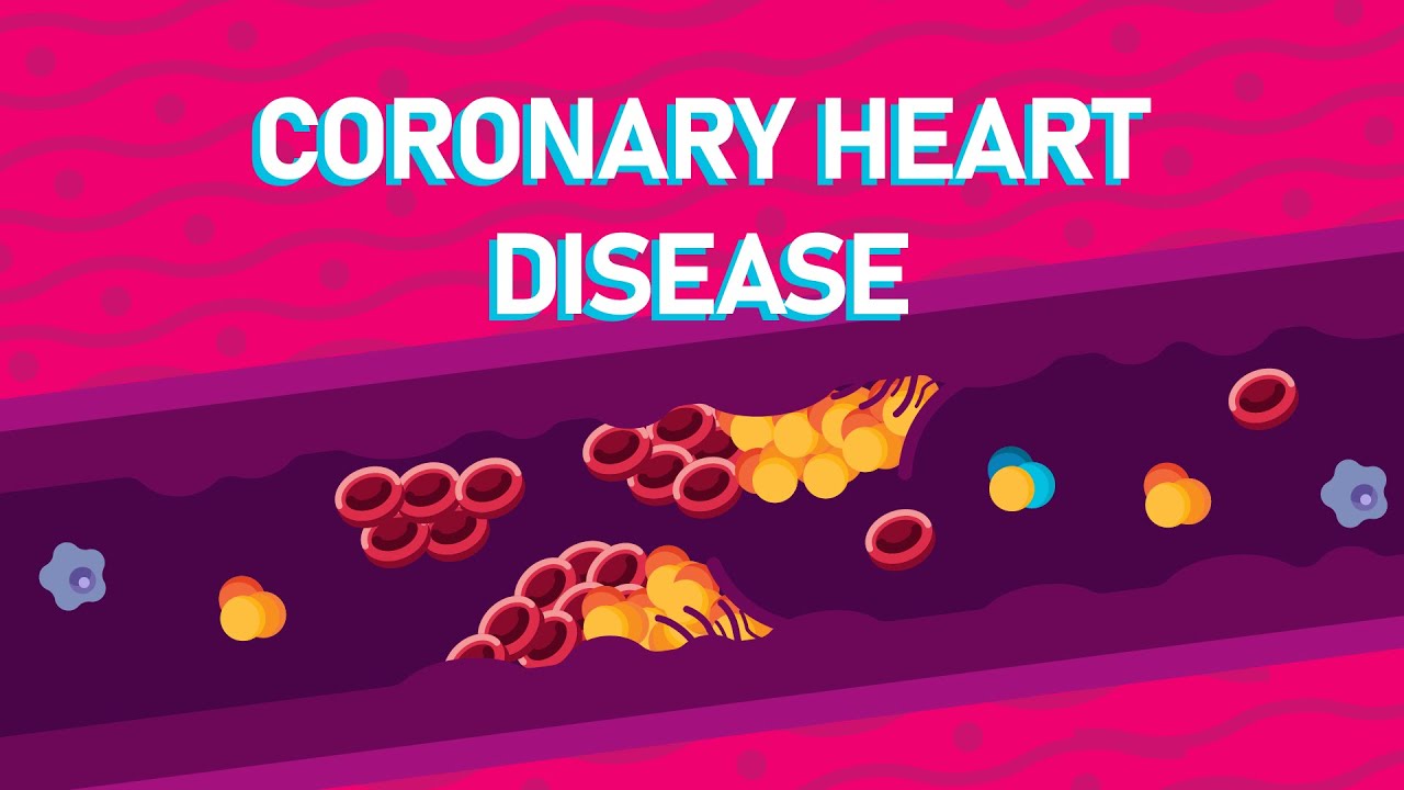 You are currently viewing What Happens During A Heart Attack? – What is Coronary Heart Disease?