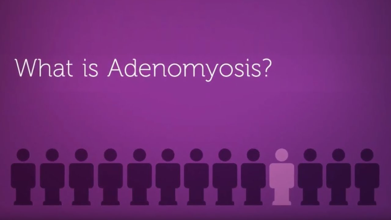 You are currently viewing What is Adenomyosis? (Enlarged Uterus)