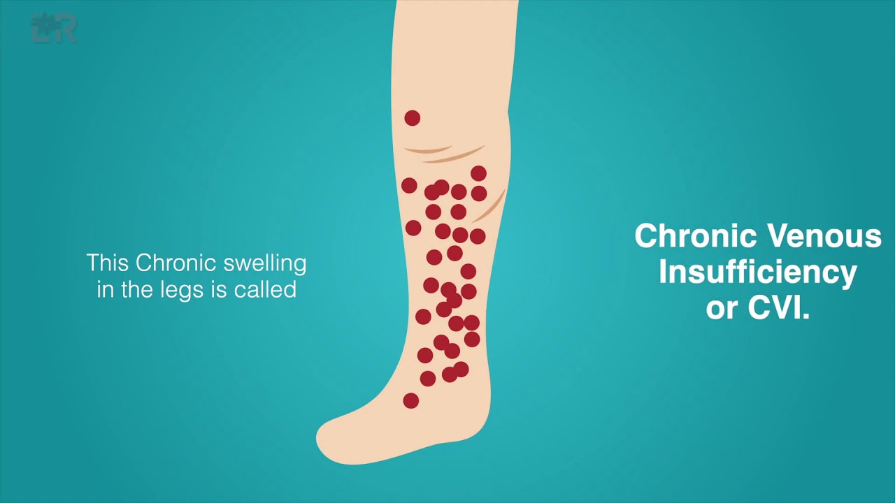You are currently viewing What is Chronic Venous Insufficiency (CVI?)