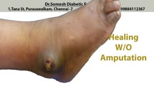 #Abscess Lateral Malleolus before after video