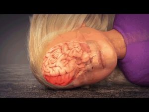 Coup-Contrecoup Brain Injury Animation