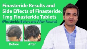 Finasteride Results and Finasteride Side Effects | Finasteride 1mg Tablets Before and After Results