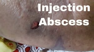 Intramuscular Injection Abscess