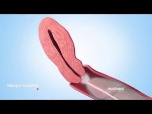 Sperm Retrieval Techniques