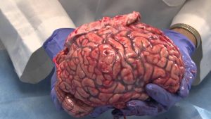 The Normal Unfixed Brain: Neuroanatomy Video Lab – Brain Dissections
