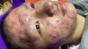 Treatment of acne tablets, pustules and blackheads (358) | Loan Nguyen