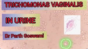 Trichomonas Vaginalis | In urine | Short Video.