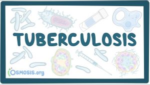 Tuberculosis – causes, symptoms, diagnosis, treatment, pathology