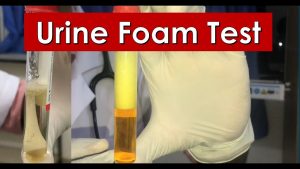 Urine Foam Test | Bile In Urine | Foamy Urine | Mediracewars